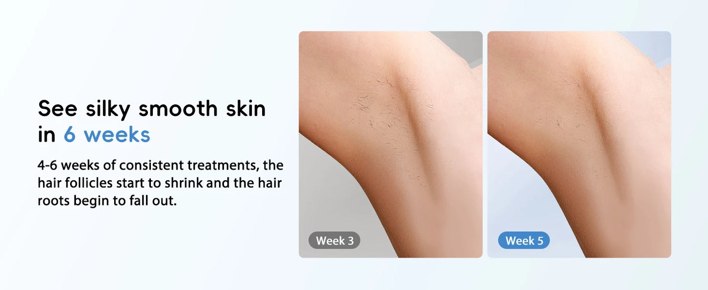 JOOYEE™️Hair Removal Laser IPL 22 Unlimited IGBT 5.2 cm² light Quick Flashes Painless Epilator Face Armpit Bikini Laser